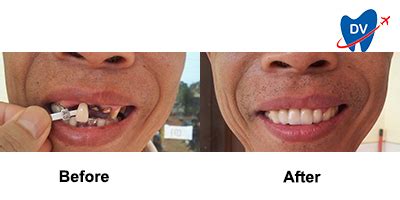 Dental Implant Clinics in Cambodia .